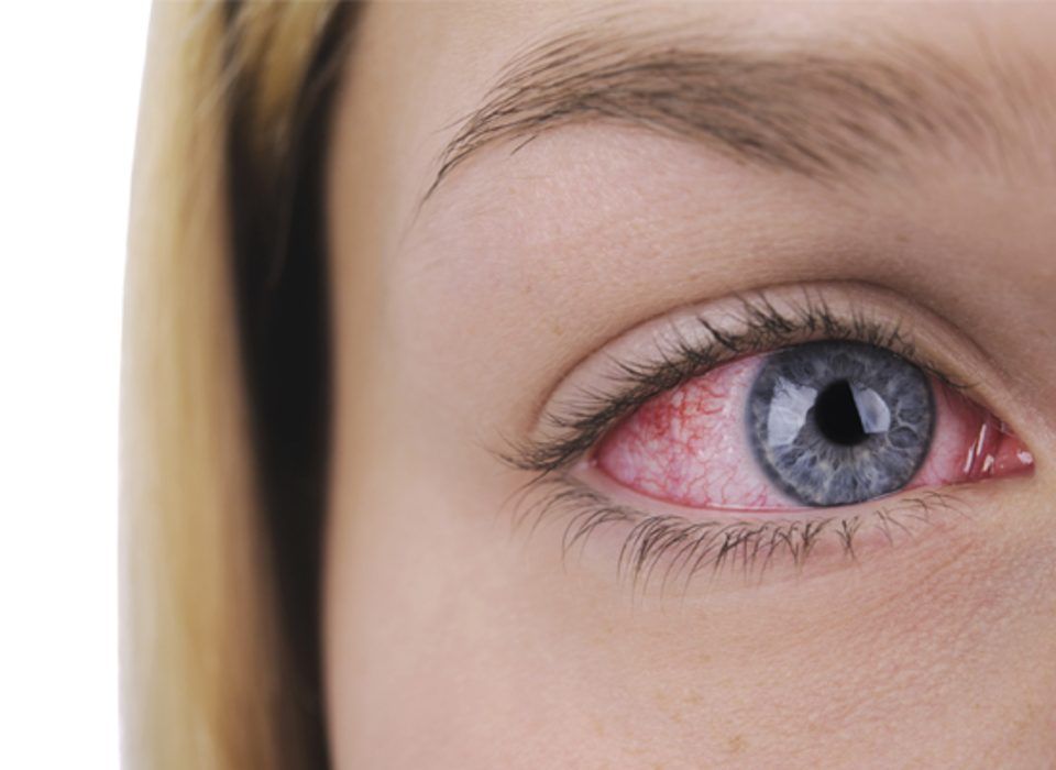 ojos rojos