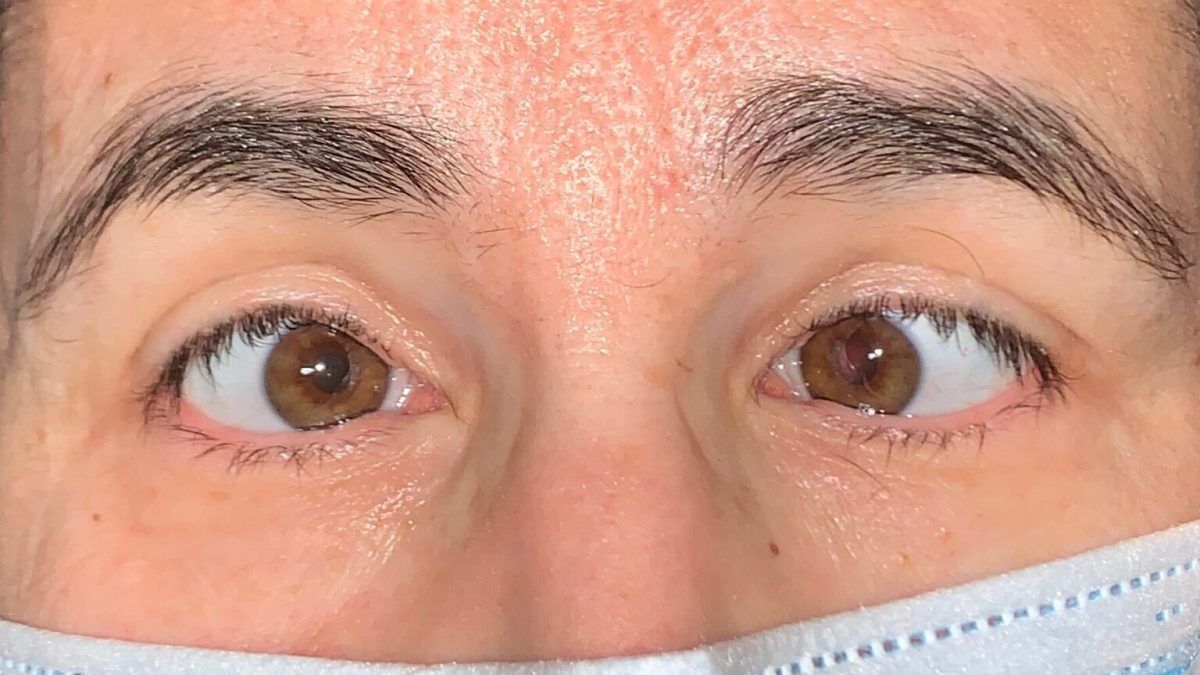 Cómo se Cura el Estrabismo en Adultos