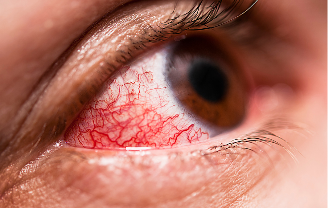 Conjuntivitis Alérgica: Causas, Síntomas y Tratamiento