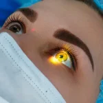 Opciones de tratamiento para el glaucoma antes de la cirugía